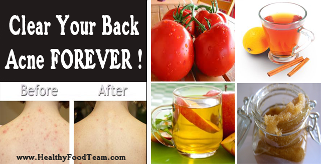 Home Remedies That Will Clear Your Back Acne Forever !