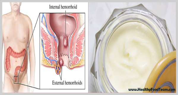 An Effective Homemade Ointment for Hemorrhoid Treatment