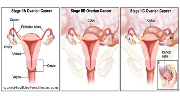 8 Early Warning Signs Of Ovarian Cancer You Shouldn’t Ignore