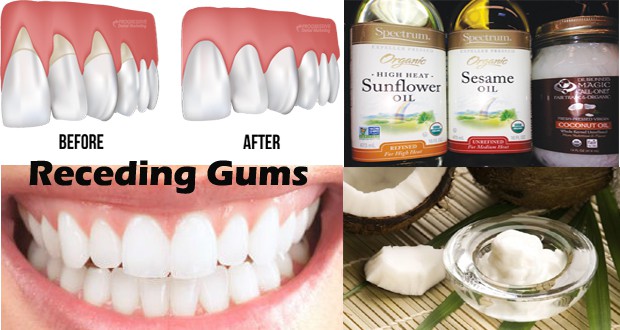 Natural Home Remedies For Receding Gums Natural Home Remedies For Receding Gums