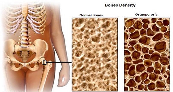 These 3 Foods Are the Biggest Guardians Of Your Bones And Protect Against Osteoporosis!