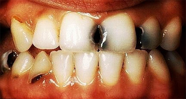 You Eat Them Every Day and They Destroy Your Teeth