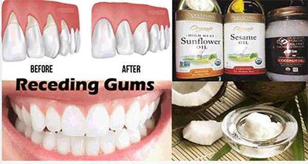 Gum Disease The Silent Killer, 7 Home Remedies To Cure It Naturally