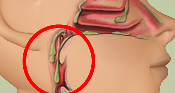 Studies reveal 4 foods to avoid to reduce mucus