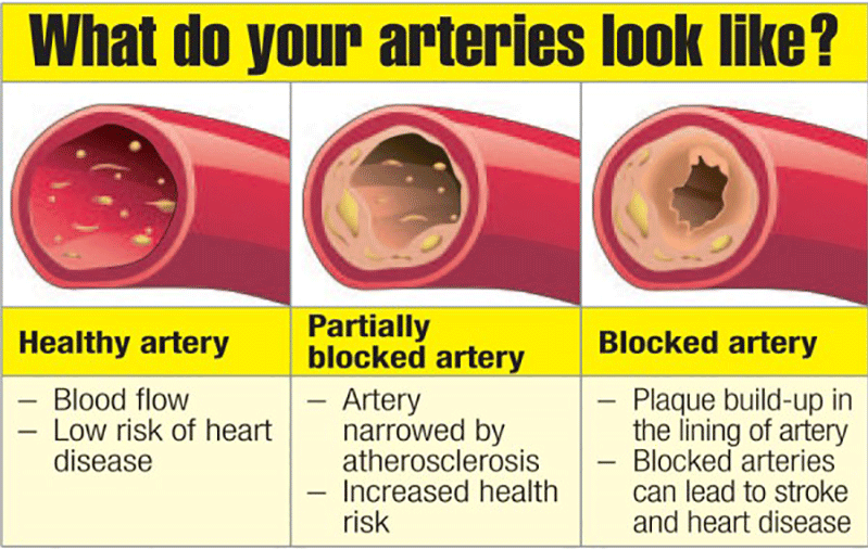 3 Simple Rules Will Help You Unclog Your Arteries Naturally