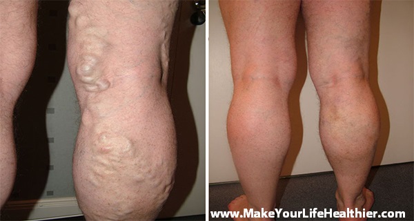 How to Cure Varicose Veins with Chestnut
