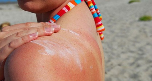 sun_burn_sunscreen_640