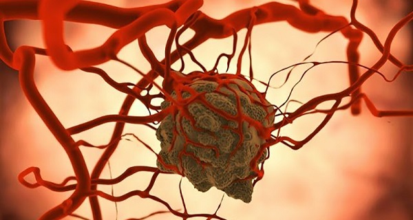 MRI Shows Cancer Cells Thrive On Processed Sugar