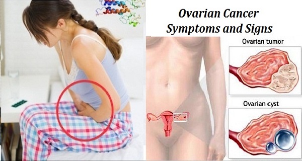 Never Ignore this Early Signs of Ovarian Cancer – Symptoms and Signs!