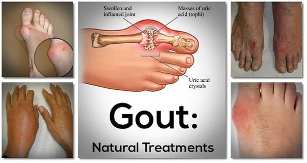 Say Goodbye To Gout Forever With This Powerful Natural Treatment !