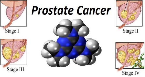 Stop the Spread of Prostate Cancer with One Root!