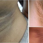 Dark Armpits? Quick and Easy Way to Clean Them – 100% Proven Recipe ! image-8580