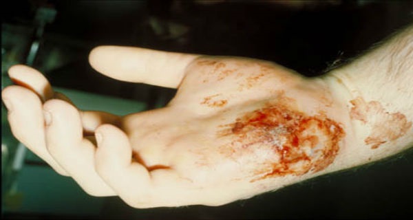 Emergency Snake Bite, What To Do And What Not To Do