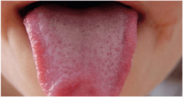Natural Remedies for Disinfecting Your Tongue Naturally