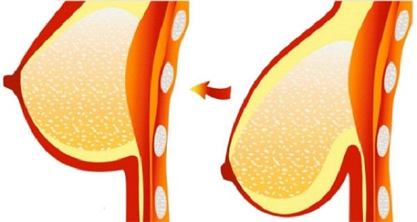 A NATURAL WAY TO AVOID HAVING SAGGY BREASTS