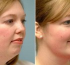 Incredible Exercises to Tighten Up Your Loose Skin and Lose Double Chin