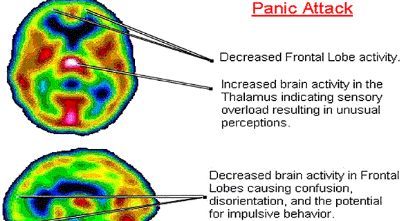 Panic Attacks and Anxiety linked to low vitamin B and Iron levels