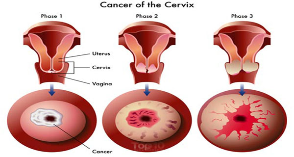 Symptoms of Cervical Cancer Which Mustn’t Be Ignored