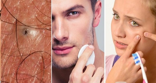 You have these 3 ingredients at home and if you mix them you will get rid of blackheads forever!