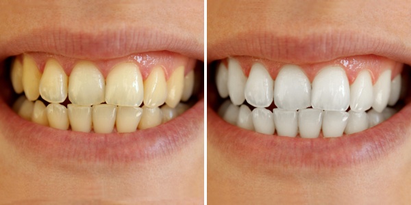 3 Ways To Whiten Your Teeth at Home