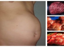 Bloating Can Indicate a Serious Health Issue. NEVER Ignore THESE Warning Signs!