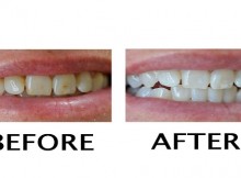 How to Remove Yellow Stains From Teeth