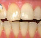 Use THIS One Ingredient to Whiten Your Teeth and Remove Plaque at Home