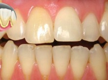 Use THIS One Ingredient to Whiten Your Teeth and Remove Plaque at Home