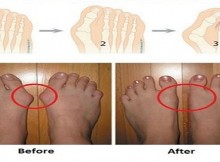 For This You Do Not Need Surgery 5 Ways To Remove The Knuckles And Heal Swollen Joints in Just 7 Days!