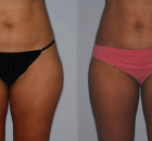 How to Lose Weight from Your Hips Fast