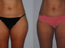 How to Lose Weight from Your Hips Fast