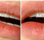 The Best Home Remedy to Get Rid of Cold Sores Overnight