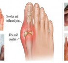 The Best Natural Remedies to Treat Gout without Surgery