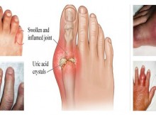 The Best Natural Remedies to Treat Gout without Surgery