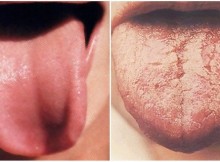 What Does your Tongue Say About Your Health