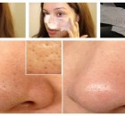 An Effective Face Mask to Remove Blackheads at Home in Two Steps
