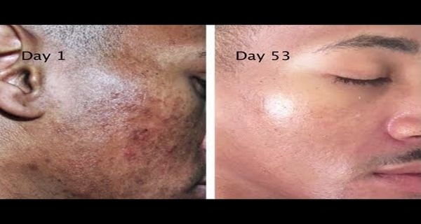 Get Rid of Stains, Spots and Hyperpigmentation with This Natural Recipe of 2 Ingredients!