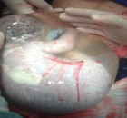 Newborn Baby Delivered Floating in Intact Amniotic Sac, En Caul, by Greek Doctor