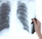 This Vitamin Cures Pneumonia in 3 Hours – Naturally!