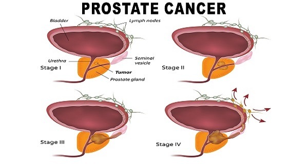 HOW TO KILL PROSTATE CANCER WITH JUST ONE ROOT!