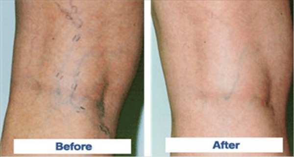 Here Is How to Make a Homemade Paste to Treat Your Varicose Veins!