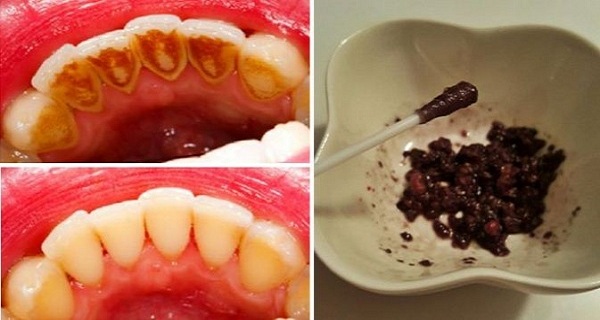 How To Whiten Your Teeth, Prevent Bad Breath, Tartar and Plaque Using Only 1 Ingredient