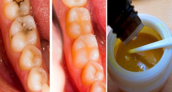Reverse Cavities Naturally and Heal Tooth Decay with This Powerful Tooth Mask!