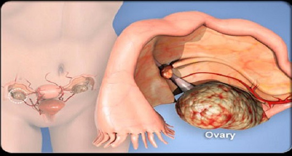Women Ignore Them, Doctors Often Misdiagnose It These Are The First Two Symptoms Of Ovarian Cancer