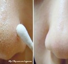 How to Remove Blackheads From Nose & Face – Indian Secret!