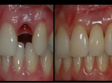 New Discovery By Dr. Jeremy How To REGROW Teeth In Your Mouth In 9 Weeks