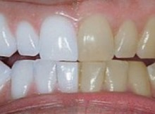 She Mixed 2 Ingredients And Put Them On Her Teeth, What It Does I’m Trying This!