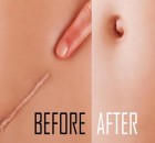 Try This Home Treatment To REMOVE Your Scars And Stretch Marks