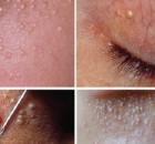 MILIA-How-to-Remove-the-Small-White-Skin-Cysts