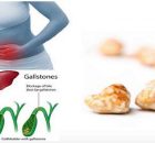 Remove Gallstones Naturally With This Simple Drink